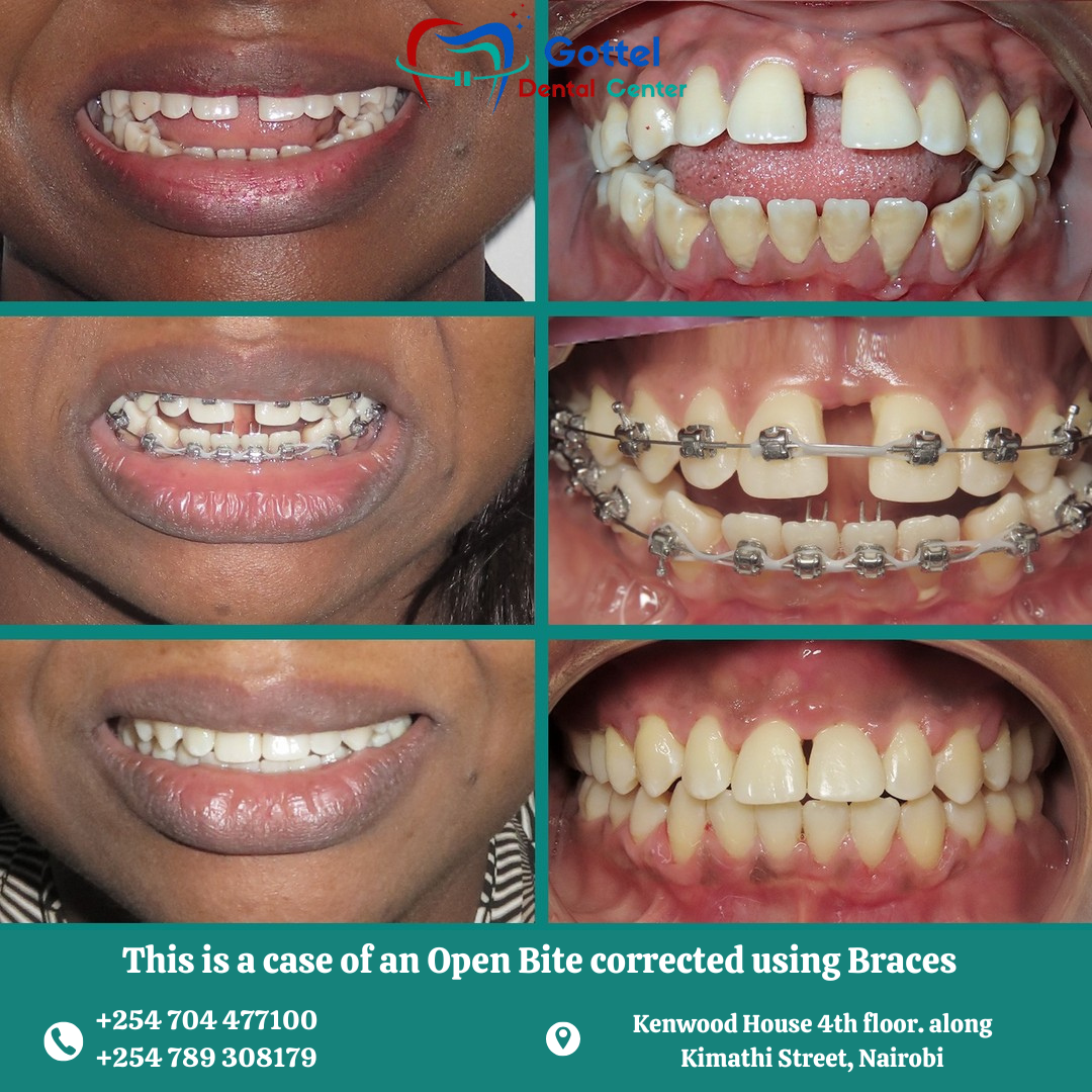 Braces transformation 5
